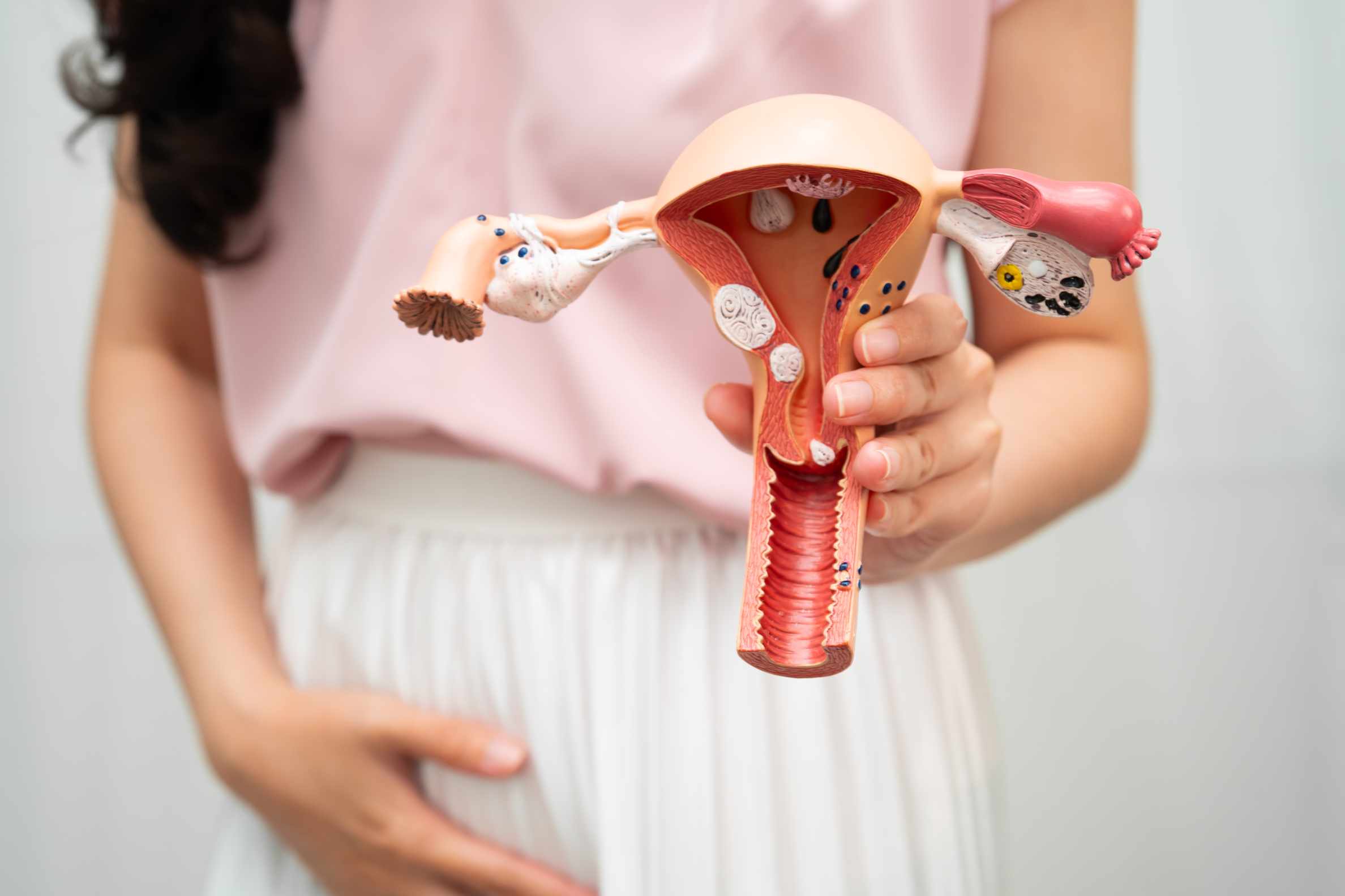 Miomatosis Uterina